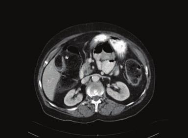Case Reports in Surgery 3 Figure 3: Follw-up abdominal CT scan showing a cholecystocolonic fistula with faeces in the gallbladder (asterisk).