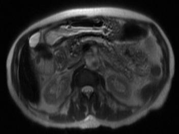 Case Report MRCP 2/11/2013: Tortuous and dilated pancreatic duct