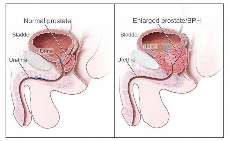 Slide 6 Benign Prostatic Hyperplasia (BPH) 6 A normal prostate, on the left, does not block the flow of urine