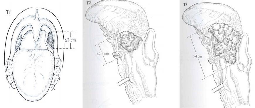 Oropharynx (p16 -) Tumor size: actual measurement