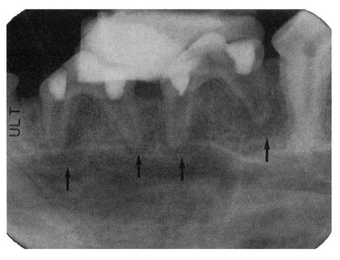 Sixty roots were infected with dental plaque and temporized with IRM (Caulk Co., Densply, Milford, DE). Six weeks later, apical periodontitis was radiographically confirmed in the infected teeth (Fig.