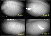 Keratograph 5 (OCULUS) Lipiscan (Tear Science) Renewing patency of MG