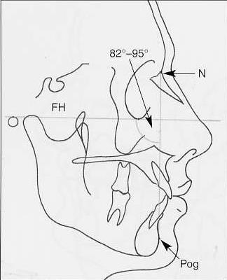 Facial angle(downs) Anteroposterior