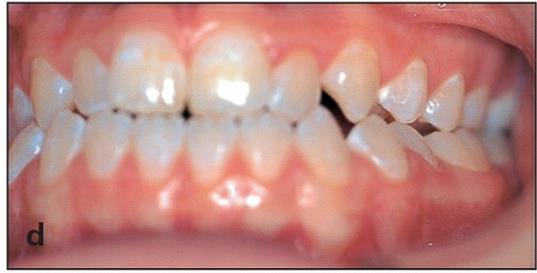Presurgical orthodontic