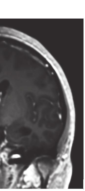 right temporal tumor 60 mm in the major axis. She underwent surgical resection of it.