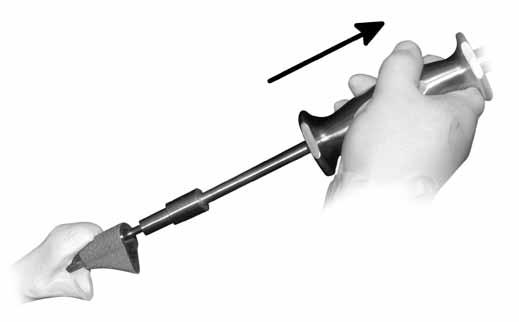 Figure 65 NOTE: Stems which are 13mm in diameter or smaller will pass through the Body Implant. Fully thread the Slap Hammer onto the Stem Implant.