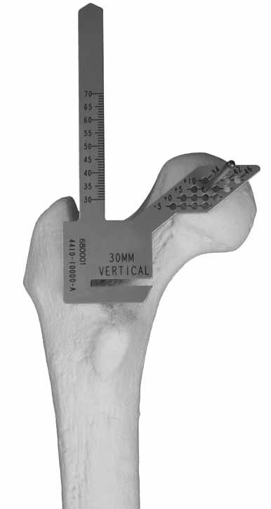 The first cut is made perpendicular to the axis of the femur, laterally towards the
