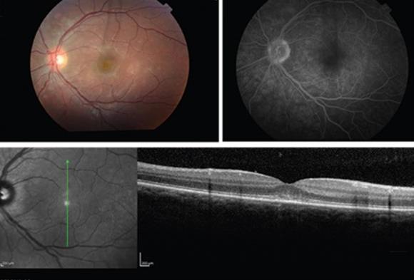 OCT markers of visual prognosis Loss of outer