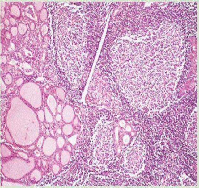 Histologically: we can observe: 1-lymphoid inflammation: the thyroid gland is destroyed due to inflammation resulting in abnormal lymphoid follicles. 2- Atrophy of follicles.