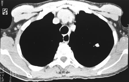 Problem Current lack of conclusive evidence on effectiveness of lung cancer (LC) screening CT screening (CT), chest