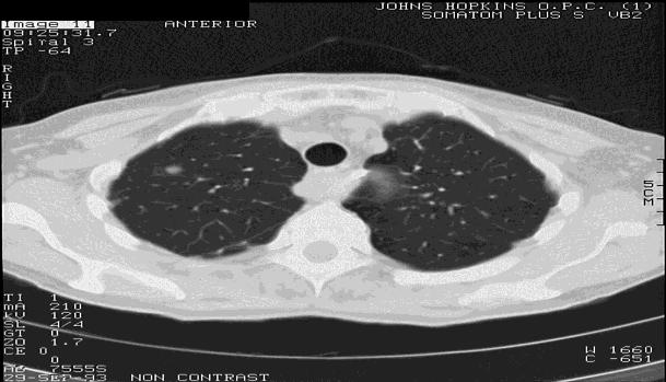Lung Cancer Screening H&P: CT every 6-12 months for 2 years then annual for 5 years CXR/sputum: Not recommended for screening Low Dose CT: The National Lung Screening Trial Reduced mortality in a