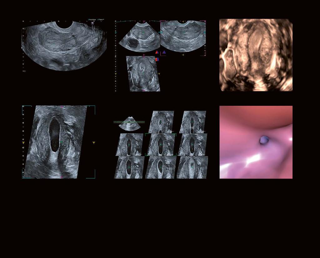 Advanced 3D Ultrasound Incorporating Fly Thru Virtual Imaging Promotes the Concept of Ultrasound Hysteroscopy 5 involves atypical ovarian activity.