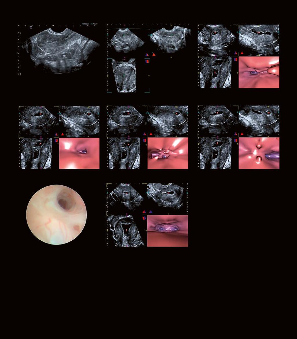Advanced 3D Ultrasound Incorporating Fly Thru Virtual Imaging Promotes the Concept of Ultrasound Hysteroscopy 7 Case 5: Multiple intracavital uterine adhesions Fig. ai Fig. aii Fig. bi Fig. bii Fig.