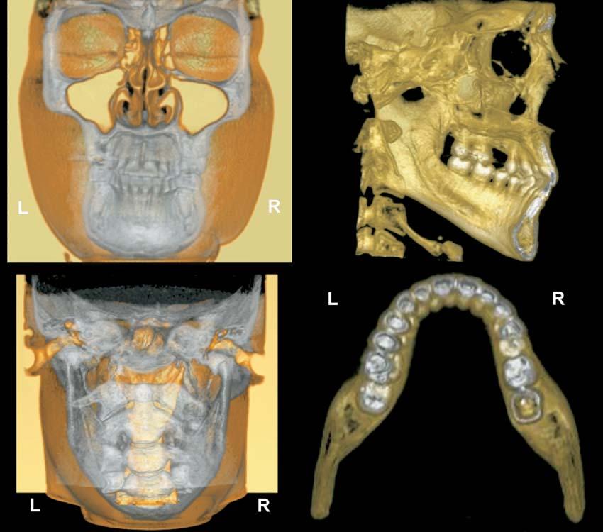 projections. Maximum intensity projection images show relationships of many elements (eg, angulation of tooth roots in alveolar bone) because of their transparent nature. Fig 10.