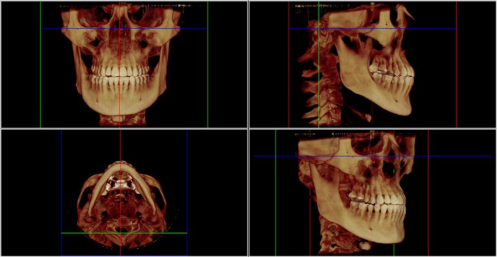 Oliveira et al. Progress in Orthodontics (2017) 18:22 Page 2 of 6 congenital craniofacial syndromes were excluded.