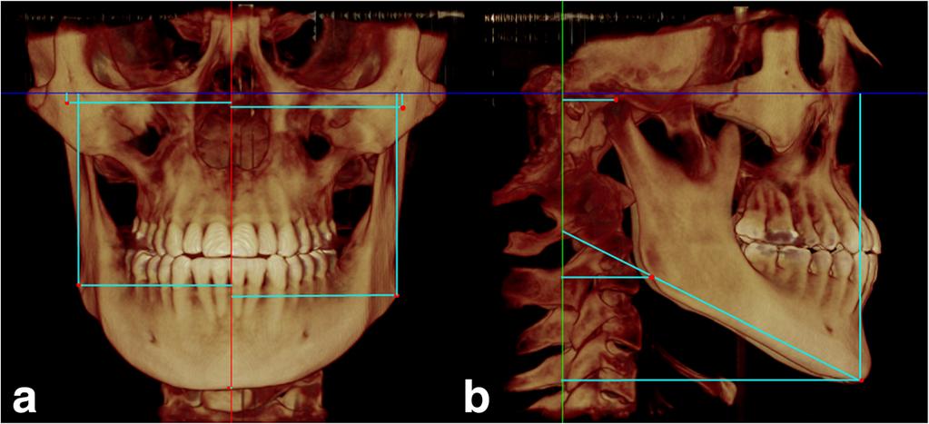0 (SPSS, Chicago, IL, USA) with a significance level of 5% (α = 0.05). Results The mandible showed a mean lateral displacement of 1.08 mm (SD = 0.93) immediately after SARME.