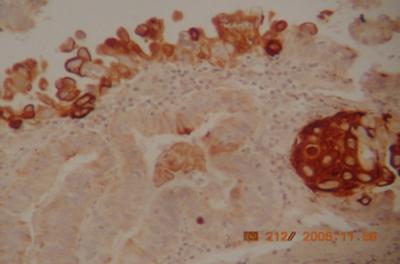6-Moderate ck5/6 immunostaining in poorly differentiated endometrial adenocarcinoma grade 111 (10x) Figure 13 Fig.