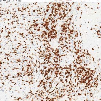 T-cell infiltration in some tumors High