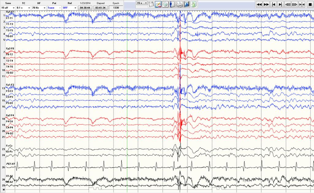 Juvenile Myoclonic Epilepsy 4-6 Hz