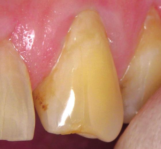 ) Completed GC Fuji VII EP root surface protection Root surface caries in