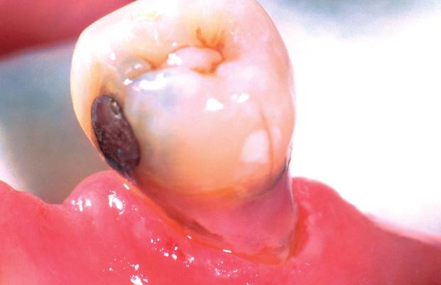 3 reasons why exposed root surfaces are at high risk of dental problems: 1.