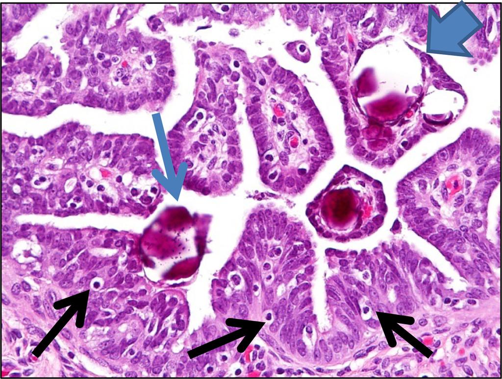 Kurman et al. Page 18 Fig. 6. Papillary tubal hyperplasia.