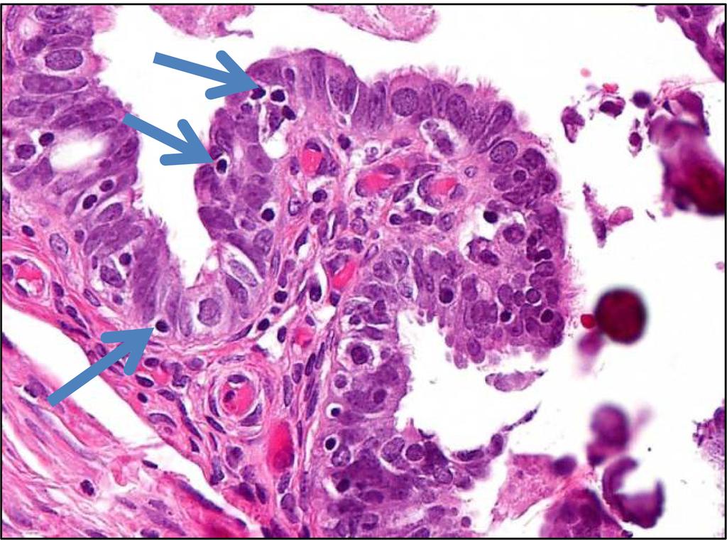 Kurman et al. Page 19 Fig. 7. Papillary tubal hyperplasia. Papilla arising from mucosa before it becomes pinched off.