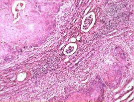 Fig 3: Photomicrograph showing squamous cellcarcinoma in a background of dense chronic inflammatory infiltrate and fibrosis. (H &E x200) References 1. M. Al-Assiri M,. Al-Otaibi M.F,.