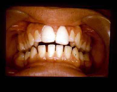 of the anomalies of the dentition