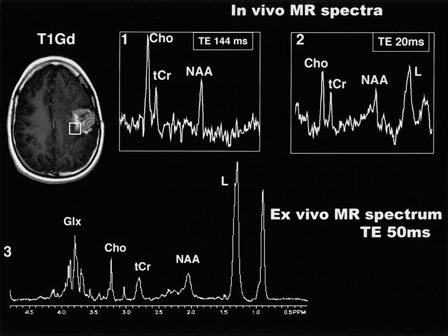 In vivo and ex vivo MR spectroscopy in pediatric brain tumors FIG. 1. In vivo and ex vivo HRMAS proton MR spectroscopy readings obtained in a GBM.