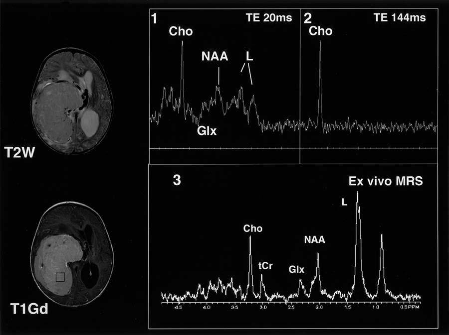 A. A. Tzika, et al. FIG. 2. In vivo and ex vivo HRMAS proton MR spectroscopy readings obtained in a choroid plexus carcinoma.