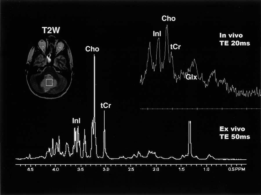 In vivo and ex vivo MR spectroscopy in pediatric brain tumors FIG. 3. In vivo and ex vivo HRMAS proton MR spectroscopy readings obtained in medulloblastoma.