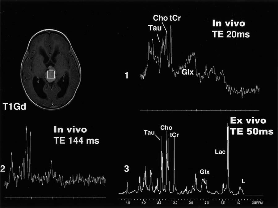 In vivo and ex vivo MR spectroscopy in pediatric brain tumors FIG. 5. In vivo and ex vivo HRMAS proton MR spectroscopy readings obtained in pineoblastoma.