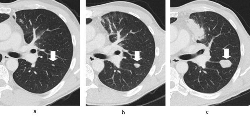 The group of patients with radiologic progression of their PFNs consisted of smokers, former smokers and non-smokers.