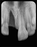 Avulsion of permanent teeth Avulsion of permanent teeth is seen in 0.5 3% of all dental injuries (1,2).