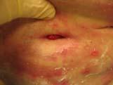 infection improper sizing of fascia or skin as stoma constructed scar formation