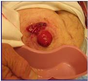 An ulceration which occurs with the use of rigid barrier with a firm abdomen.