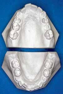 6 Transverse Skeletal Alteration 32.7 Table 6-1 Intercanine width after extraction (mm) T1 T2 T3 J. M. Alexander 25.7 26.8 25.8 24.