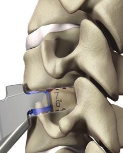 Optio-C Anterior Cervical PEEK Interbody System Surgical Technique Guide 15 Implant Placement: ATO Inserter Guide Fig.