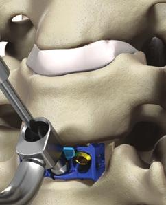 Optio-C Anterior Cervical PEEK Interbody System Surgical Technique Guide 17 Midline Screw Hole Preparation/ Screw Placement: ATO Inserter Guide Fig.
