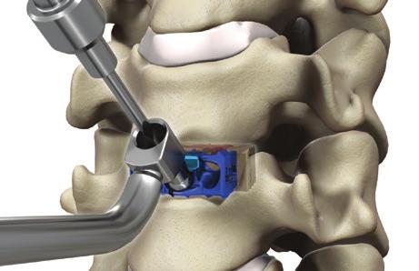 Ensure that the guide tip is fully seated. The appropriate angle ranges for the midline screw are 35 to 45 cephalad/caudal and 0 to 10 medial/lateral.