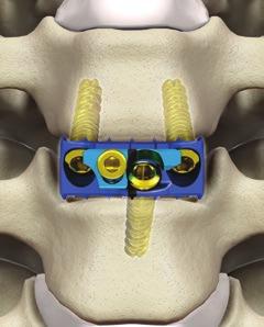 22 Optio-C Anterior Cervical PEEK Interbody System Surgical Technique Guide Fig. 44 Step 7 (continued) Turn the Driver clockwise.