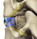 Optio-C Anterior Cervical PEEK Interbody System Surgical Technique Guide 5 All Optio-C System PEEK spacers have two notches and a groove to accommodate Optio-C System bone screws.