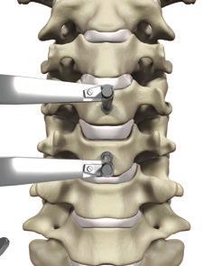 6 Optio-C Anterior Cervical PEEK Interbody System Surgical Technique Guide Optio-C System Surgical Technique Preoperative Planning and Patient Positioning Exposure, Location and Site Preparation Fig.