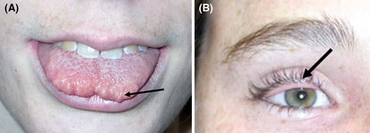 294 C. J. WRAY ET AL. FIG. 1. Patient photographs displaying the common facial features of the MEN 2B phenotype, including mucosal neuromas of the tongue (A) and everted upper eyelids (B).
