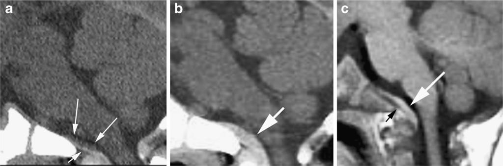 Resolution ws confirmed on brin MRI performed 7 h post symptom onset (not shown) Fig. 3 CT nd MRI in 7-month-old girl with retroclivl subdurl collection (cse 11).