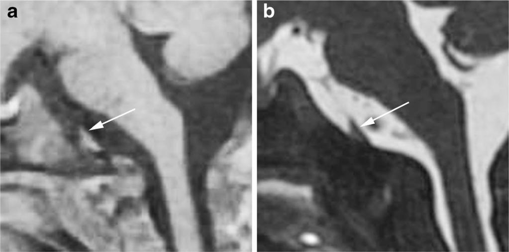 S628 Peditr Rdiol (2014) 44 (Suppl 4):S621 S631 Fig. 7 MRI in 1-month-old boy with retroclivl collection (cse 18, indeterminte).
