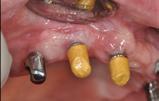 prosthetic treatment in Maxillary full arch treatment Different treatment options for