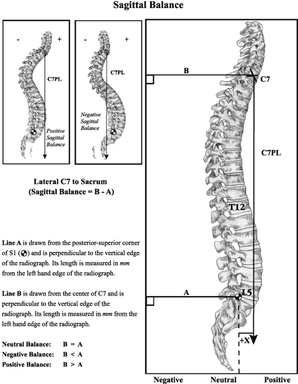 684 Spine Volume 30 Number 6 2005 Table 3. Curve Location versus Outcome Measures in Patients Without Prior Surgery Curve location Thoracic Other P Value N 44 128 Pain Less pain SRS-22 3.5 3.1 0.