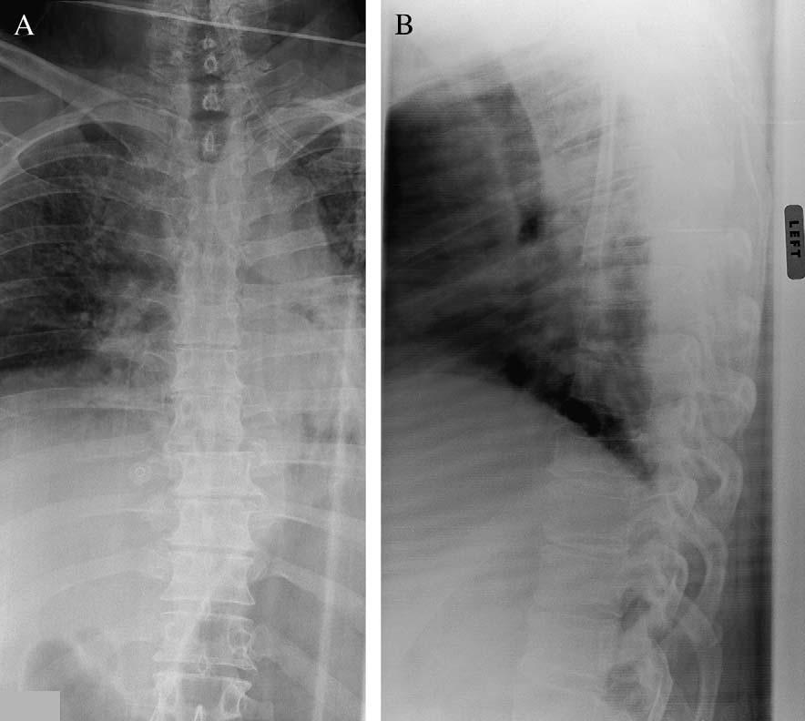 G.P. Lekovic et al. / The Spine Journal 6 (2006) 330 334 331 Fig. 1. Thoracic plain (A) anteroposterior and (B) lateral radiographs show diastasis of the eighth and ninth thoracic vertebrae.